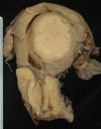 Cervical cancer is a cancer arising from the cervix. 29 17c Cervical Cancer Medicine Libretexts