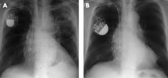 Implantable cardioverter defibrillator (icd), and how they differ from brady pacemakers. Biventricular Icd Pacemaker