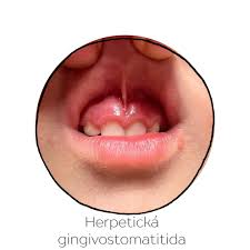 Image result for Puchýře na jazyku