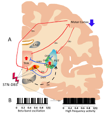 Image result for Thalamic Stimulation
