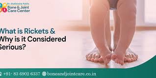 Image result for Rickets