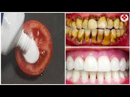 In 2 Minuti Sbiancare I Denti Con Questo Metodo Magico Trasforma I Denti Gialli In Bianco Perla Youtube Dogal Dis Beyazlatma Dis Sagligi Saglik