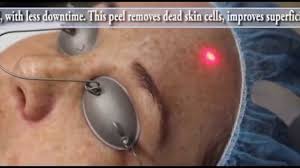How can you treat dark spots on your face? The Brand New Laser Peel To Treat Dark Spots Youtube