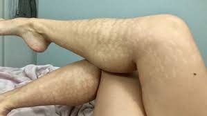 Sun exposure makes laser hair removal less effective and makes complications after treatment more. Laser Hair Removal Left Exotic Dancer With Unsightly Marks Lawsuit Alleges Ctv News