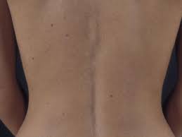 Image result for Diffuse Hyperpigmentation