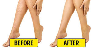 Razor bumps, or ingrown hairs, are small, irritated bumps on the skin. 10 Natural Remedies For Irritation After Shaving