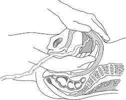 Manual placenta removal — is a procedure to remove a retained placenta from the uterus after childbirth.1 it is usually carried out under anaesthesia or more rarely, under sedation and analgesia. 9 2 Manual Removal Of The Placenta Essential Obstetric And Newborn Care