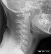 They show pictures of your internal tissues, bones, and organs. Lateral Cervical Spine Radiograph X Ray How To Read