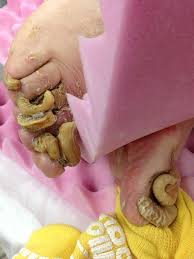 Image result for Onychogryphosis feet