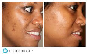 Too much melanin leads to hyperpigmented skin, common examples. Chemical Peels Southern Cosmetic Laser Charleston Botox And Skin Care