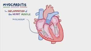 Image result for Myocarditis