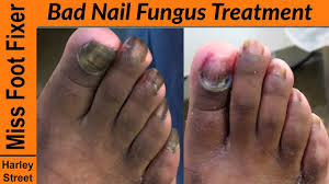 Bad Toenail Fungus Treatment How To Cut Fungal Nails Youtube