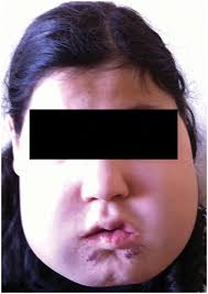 Full article: Vascular Anomalies of the Head and Neck: A Review of Genetics