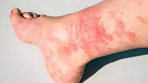 Disney Rash Pictures Treatment Prevention