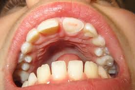 Your Options To Fix A Tooth Broken In Half