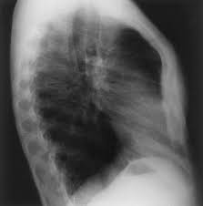 Aka poland anamoly or poland sequence. Imaging Of Chest Wall Disorders Radiographics