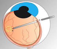 Retina Cerrahisi - Vitrektomi Ameliyatı | NeoRetina