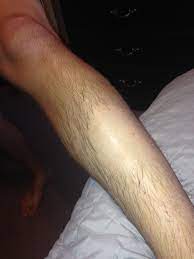 Pin On Hair Removal