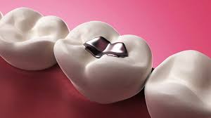 If they are in the way, your orthodontist may. How Long Do Fillings Crowns Root Canals Last Dentist In Nw Calgary Metro Dental Care