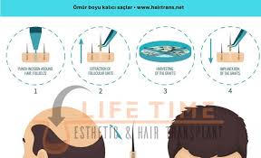 Fue Yontemi Life Time Esthetic Hair Transplant Sac Adalar