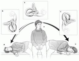 Image result for Canalith Repositioning Procedure