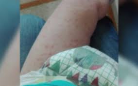 Oficialii dsp dau vina pe părinții copiilor. Oms Recomanda Adultilor Din Romania Vaccinarea Voluntara Impotriva Rujeolei Boala A Facut 31 De Morti La Noi In Tara Stirileprotv Ro