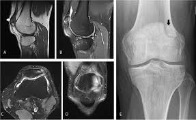 Knee muscle anatomy axial mri : Common Mistakes And Pitfalls In Magnetic Resonance Imaging Of The Knee