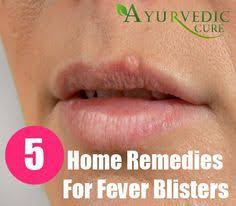 5 Best Home Remedies For Fever Blisters Home Remedies For Fever Fever Blister Remedy Fever Blister