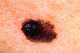 Below are photos of melanoma that formed on the skin. This Real Housewife Just Shared A Picture Of Her Skin Cancer