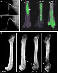Early detection of cancer and treatment is the best solution i can suggest to you. Bone Cancer Pain Causes Consequences And Therapeutic Opportunities Sciencedirect