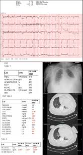 Case Study 60 Year Old Female Presenting With Shortness Of Breath Article