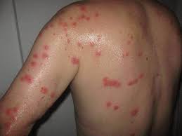 What does a spider bite look like? Have You Ever Gotten A Real Spider Bite I M Looking For Photos Spiders