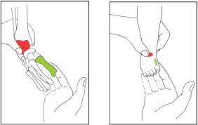 We did not find results for: Ponseti Method For Clubfoot Treatment