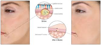 Taking the realm one step forward are led light let us review each of these amazing devices one by one. Lightstim San Francisco Mill Valley Led Light Therapy