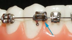 In cases where the wire is poking, you can cut the wire closest to the nearest bracket that is attached. Orthodontic Emergencies What To Know And What To Do