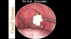 Walnut sized white clumps in throat. Huge Tonsil Stones Removal In A Case Of Chronic Tonsillitis Allergic Rhino Sinusitis Youtube