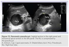 Image result for what is normal pancreas size