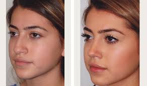 He may not be the big star that he is had he had my procedure itself only took 20 min.i remember looking at the clock before and after the procedure. Rhinoplasty Before And After Nose Job Before And After