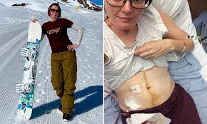 Initial common symptoms in patients presenting with colon cancer are abdominal pain, change in bowel habits, melaena, and general weakness  5 . Keen Snowboarder 38 Discovers What She Thought Was A Hernia Is Stage Four Bowel Cancer Daily Mail Online