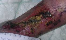 Een klein ulcus kan in de eerstelijnszorg genezen door een combinatie van. Martorell Hypertensive Ischemic Leg Ulcer Must Not Be Confounded With Pyoderma Gangrenosum Management Is Totally Different Sciencedirect
