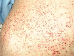 Petit points rouges sur la peau. Epingle Sur Sante