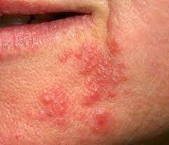 We did not find results for: Ananasallergie Ursachen Und Symptome Mit Bildern Was Hilft