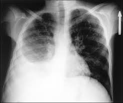 Pleural fluid ldh > two thirds of upper limit for serum ldh. Pleural Effusions In The Pediatric Population American Academy Of Pediatrics
