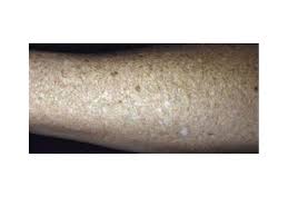 Tiny creases on tanning bed can restrict the free flow of blood to certain parts of your body that is pressed against it and hence causing small white patches. White Freckles On My Arms What Are They Eudelo