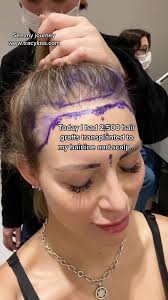 #femalehairtransplant #femalehairtransplantbeforeandafter #hairtransplant  #hairtransplantturkey #hairtransplantation #hairtransformations  #hairtransplantdr #hairtransplantnetwork ...