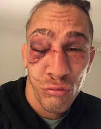 Luque png cliparts, all these png images has no background, free & unlimited downloads. Extent Of Niko Price S Eye Injury After Ufc Star S Defeat To Vicente Luque Daily Star