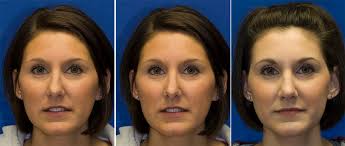 What are extended spreader grafts? Spreader Grafts Rhinoplasty In Seattle Rhinoplasty Surgeon