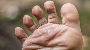 Image result for brown patches on the feet