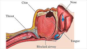 Image result for sleep apnea mechanism image