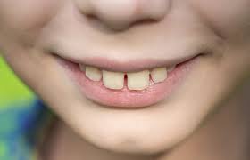 Jan 11, 2018 · the most common technique is the use of rubber bands to close the spaces between the front teeth. How Do Teeth Move How Fast Do Teeth Move With Braces Find Out